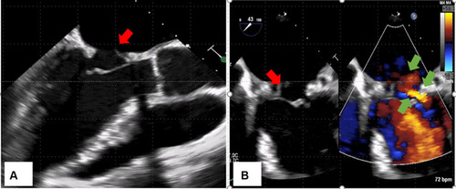 Figure 1 Transesophageal echocardiography (A) 135°, (B) Mitral valve commissure (60°). Mobile vegetation, 25 mm in size, is observed in the anterior mitral valve annulus (red arrow). Valve destruction is not observed. This is the portion exposed to reverse flow (green arrow).