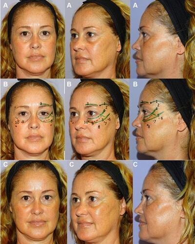 Figure 10 Forty-five years old women with a tear trough deformity (according to Belhaouari classification: 1B (see reference 7)) before treatment (A); that shows the treatment plan (B); and after treatment (C). The patient provided their consent for the use of their image in this publication. 1. Temporo-orbicular cutaneous retaining ligament; 2. Anterior temple (T1); 3. Palpebral ligament; 4. Orbicular retaining ligament; 5. Zygomatic-cutaneous-orbicularis retaining ligament; 6. Zygomatic arch (Ck1); 7. Zygomatic eminence (Ck2); 8. Anteromedial cheek (Ck3); 9. Central infraorbital (Tt1); 10. Medial infraorbital (Tt3). T1 (2): 0.5 mL per side of Hyaluronic acid (HA) filler (VYC-25L; Volux®; Allergan plc, Dublin, Ireland). Ck1 (6): 3 microboluses of 0.1 mL (one in the suture notch and the other two ones to the sides) of HA filler (VYC-20L). Ck2 (7): 0.1 mL of HA filler (VYC-20L). Ck3 (8): 0.2 mL lateral + 0.25 mL medial of HA filler (VYC-20L). Tt1 (9): 0.2 mL of HA filler (VYC-20L). Tt3 (10): 0.2 mL of HA filler (VYC-20L). Image courtesy with permission from courtesy of Dr Urdiales-Gálvez. Codes have been adapted from de Maio.Citation10