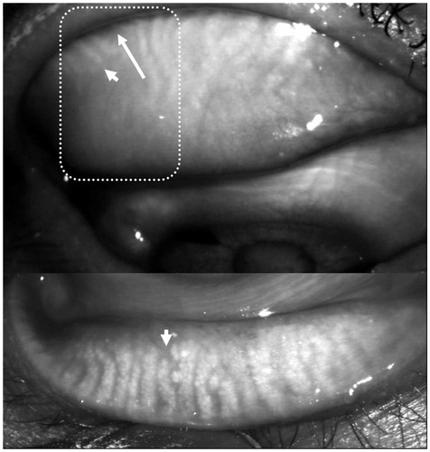 Figure 3 Image of the meibomian gland from a 74-year-old man, captured using a digital ophthalmoscope with eyelids inverted. Meibomian gland dropout (arrow) and shortening (arrowheads) can be observed.