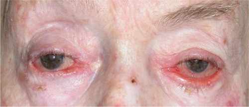 Figure 1 Severe left lower lid ectropion in an 80-year-old patient treated with Cosopt (dorzolamide hydrochloride–timolol maleate) and Alphagan (alpha 2 agonists) for 10 years.