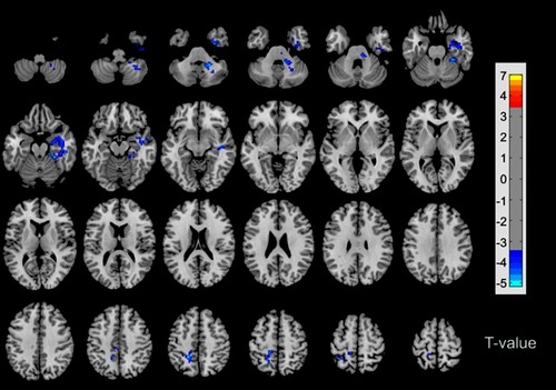 Figure 1 Results of altered ALFF in PD patients compared with HCs. The blue color represents deactivation. The color bar represents T values. In addition, the left side of the picture corresponds to left hemisphere and the right side corresponds to the right hemisphere. The Gaussian Random Field (GRF) correction was used for the statistical significance of group differences (voxel p-value <0.001, cluster p-value <0.05).Abbreviations: ALFF, amplitude of low-frequency fluctuation; PD, primary dysmenorrhea; HCs, healthy controls.