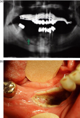 Figure 1.  A case of ONJ in a patient treated with zoledronate (24 administrations) and docetaxel (75 mg/m2 q3wks for a total of 5 months of treatment). Panel a) panoramic radiograph of the mandible showing classic lytic bone radiolucency in the site of a prior tooth extraction (green arrow). b) Bone necrosis exposure in the mandibula at the corresponding X-ray site.
