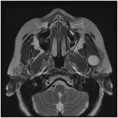 Figure 2. Axial T2-WI showing a well-circumscribed hyperintense lesion lying between the masseter muscle and the mandibular ramus, with a thin layer of masseter separating it from the parotid gland.