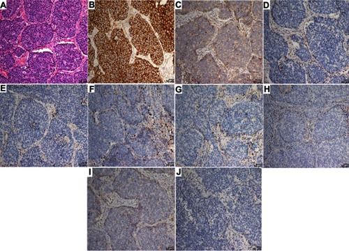 Figure S1 Representative images of each diagnostic category for LCLC.Notes: According to the 2015 World Health Organization classification of tumors, the morphological features of LCLC were considered through IHC: (A) H&E staining of LCLC; (B) CK staining positive observed in tumors characterized by epithelial origin; (C–E) negative IHC staining with neuroendocrine markers, CD56, CgA, and Syn; (F–J) negative IHC staining with TTF1, napsin A, p40, CK5/6, and p63 to identify glandular or squamous differentiation.Abbreviations: LCLC, large-cell lung carcinoma; IHC, immunohistochemistry.