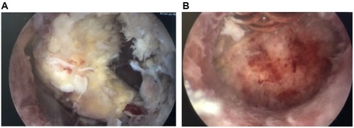 Figure 1 The photo on the left (A) shows a retained portion of placenta approximately 8 weeks after delivery. The photo on the right (B) shows the same uterus following hysteroscopic morcellation of the retained placenta.