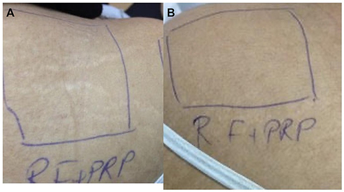 Figure 4 (A) Striae on the back before treatment, (B) improvement of striae after 3 sessions of combined treatment.