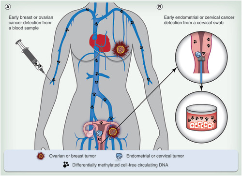 Figure 4.  Differentially methylated DNA biomarkers for early cancer detection. (A) Cell-free circulating tumor DNA from a blood sample for detection of breast and ovarian cancers from which tissue cannot be obtained readily; and (B) tumor DNA from vaginal fluid for the detection of endometrial and cervical cancers.