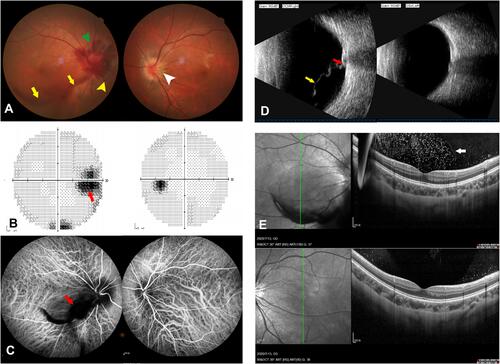 Figure 3 Multimodal imaging of Case 2 diagnosed as IHAPSH. (A) Hemorrhage in intrapapillary (green triangle), peripapillary subretinal (yellow triangle), incomplete posterior detachment and hemorrhage of vitreous body (yellow arrow) in her right eye, and a small tilted optic disc in the left eye (white triangle). (B) Enlarged physiological scotoma in the affected eye (red arrow). (C) Fluorescence blockage due to peripapillary subretinal hemorrhage (red arrow) on ICGA. (D) Incomplete posterior detachment of vitreous body adhered to the bulged optic disc in the right eye confirmed by B-ultrasonography (yellow and red arrow). (E) Posterior vitreous membrane detachment confirmed by OCT (white arrow).