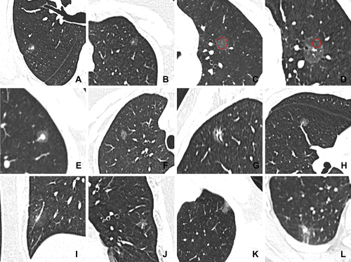 Figure 1 Representative images of CT features. (A) SSN with irregular shape and ill-defined margin; (B) SSN with regular shape and well-defined margin; (C) measurement of CT value of GGO areas for pGGN (red circle); (D) measurement of CT value of GGO areas for PSN (red circle); (E) SSN with target sign; (F) SSN with bubble lucency; (G) SSN with air bronchogram; (H) SSN with intra-nodular vessel sign; (I) SSN with abnormal intra-nodular vessel sign; (J) SSN with thickened interlobular septa; (K) SSN with pleural attachment; (L) SSN with pleural retraction.