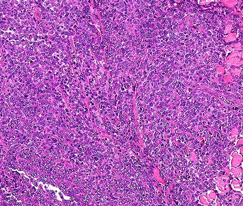 Figure 4 Histopathology of skin lesions: with large tumour cells, abundant cytoplasm, round or irregular nuclei, obvious nucleoli, obvious heterotypes, obvious interstitial phenomenon (HEx200).