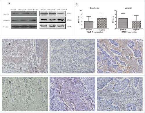 Figure 7. RACK1 was associated with the expression of EMT markers in ESCC cell lines and ESCC cases. (A) upper, expression of vimentin protein in Eca109 and EC9706 was reduced after shRNA transfection; lower, expression of E-cadherin protein in Eca109 and EC9706 was increased after shRNA transfection. (B and C) Representative immunostainings for EMT markers in a RACK1 positive sample (upper) and a negative sample (lower). Left, RACK1 expression; middle, E-cadherin expression; right, vimentin expression (×200). Vimentin was densely stained in the case of positive RACK1 staining and weakly stained in the case of negative RACK1 staining, while E-cadherin showed an inverse correlation. (D) Association of IHC scores of E-cadherin and vimentin with RACK1 expression. A significant positive correlation was found between RACK1 expression and vimentin, and an inverse correlation between RACK1 expression and E-cadherin (P = 0.0190, P = 0.0047).