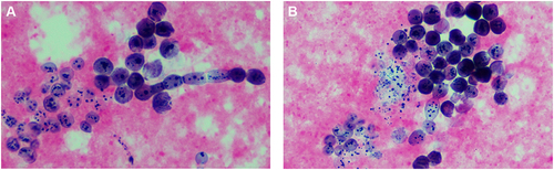 Figure 2 (A and B) Pleomorphic fungi were observed by gram staining of BALF smear.