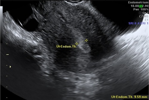 Figure 1 Two-dimensional ultrasound measurement of endometrial thickness.