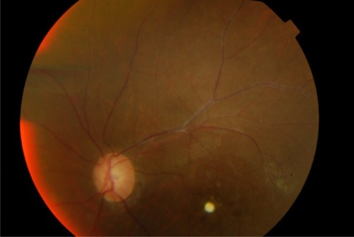 Figure 2 Twelve months postoperatively, the full-thickness macular hole was closed successfully and the retina remained attached.