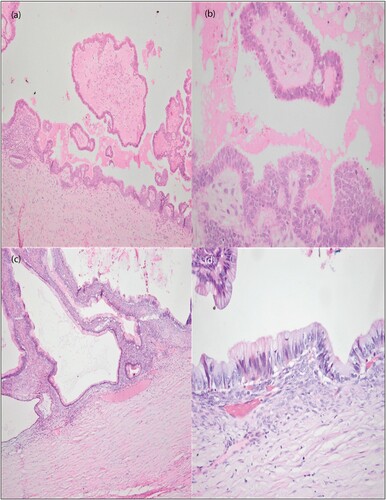 Figure 4: H&E photomicrographs of serous and mucinous borderline tumours. A demonstrates hierarchical branching papillae in a serous borderline tumour. B demonstrates epithelial stratification and mild to moderate cellular atypia in a serous borderline tumour. C shows slender filiform papillae lined by gastrointestinal type mucinous epithelium in a borderline mucinous tumour. D shows stratified epithelium with moderate cytological atypia in a borderline mucinous tumour (original magnification A and C x100, B and D x400).