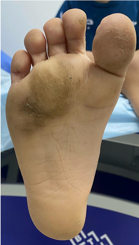 Figure 4 Symmetrical focal thickness and fissures of the skin of both feet revealing plantar keratoderma.