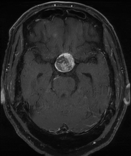 Figure 1. Large hemorrhagic mass