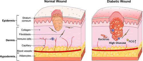 Figure 1 Skin structure and comparison of normal and diabetic wounds. The skin is composed of the epidermis, dermis, and subcutaneous layers. The outermost layer of the epidermis is the stratum corneum, which can assist the organism in retaining moisture and protecting it from external infections. The dermis is the structural framework of the skin and consists of fibers, matrix, and cellular components, and cells within the dermis include FBs, ICs, and other cells. The hypodermis is mainly composed of loose connective tissue and adipocytes and has an important function in storing energy and warmth and cushioning pressure. Compared with wounds during the normal wound healing process, diabetic wounds are susceptible to infection and delayed healing due to microenvironmental disturbances induced by HG. Additionally, diabetic wounds are adversely characterized by prominent inflammation, impaired angiogenesis and oxidative stress damage, and dysfunctional ECM remodeling.