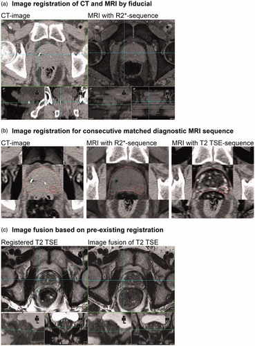 Figure 3. MR-image fusion workflow in a clinical study. (a) Image registration by GM using R2*-sequence from 3 T MRI (Skyra)*. (b) Consecutive match of T2 TSE sequence for tumor delineation. (c) Match of a weekly derived T2 TSE sequences using the marker-matched T2 TSE sequence (b) for registration on anatomical identical intraprostatic points (MRI-MRI-match). For details, see the method section. *Siemens Healthcare GmbH, Erlangen, Germany.