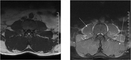Figure 2. Pre-contrast axial T1 weighted MRI of the lumbar spine (Left), Post contrast T1 weighted axialimage (Right) demonstrates heterogenous enhancement of the iliopsoas musculature (arrows)