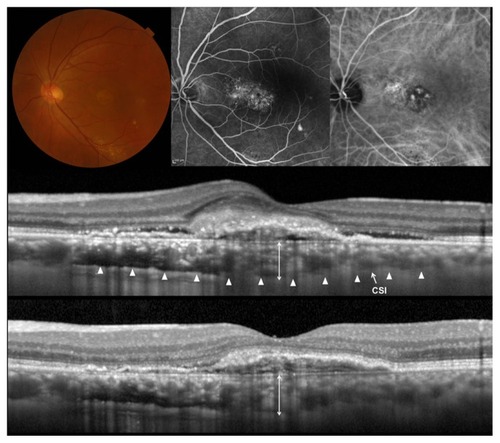 Figure 2 Polypoidal choroidal vasculopathy treated with ranibizumab.