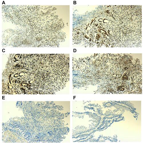 Figure 2 Immunohistochemical results of the patient. (A) MLH1 (+). (B) MSH2 (+). (C) MSH6 (+). (D) PMS2 (+). (E) PD-L1 (-) for gastric cancer. (F) PD-L1 (-) for bladder cancer.