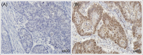 Figure 1. Immunohistochemical staining of ABCG2 in human colorectal cancer. Representative tissue sections show low (A) and high (B) expression of ABCG2. (All × 400).