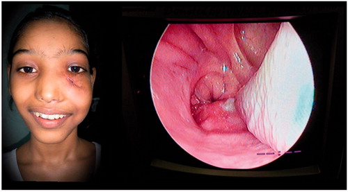 Figure 9. Post-operative scar and zero degree endoscopic view of the left nasal cavity, after 4 weeks. *Picture used after patient and relatives consent.