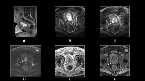 Figure 4 Sagittal T2-SSETSE (A), transverse fat-suppressed T2-weighted SSETSE sequences (B and C), DWI and ADC (D and E) and postgadolinium T1-weighted 3D-GE (F) sequence show a large infiltrative prostate cancer invading the bladder wall (arrows, c-f).