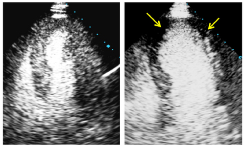 Figure 4 An example of MCE imaging showing normal enhancement at rest (left) and delayed replenishment with adenosine (resulting in low-contrast enhancement in midseptal, apical septal, and apical lateral segments) consistent with stenosis in the left anterior descending artery (right).