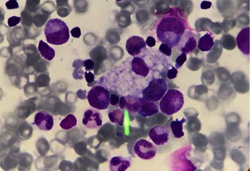 Figure 5 Vacuolated lymphocyte. Vacuolated lymphocytes may provide a diagnostic clue in many but not all lysosomal storage disorders. Although not massive in LAL-D, the presence of vacuolated lymphocytes can provide important diagnostic hints toward an underlying lysosomal storage disorder.Abbreviation: LAL-D, lysosomal acid lipase deficiency.