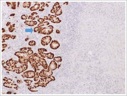 Figure 1. IHC analysis of CDX2 expression performed on formalin-fixed, paraffin-embedded tissue sections of the resected liver metastasis, which revealed a mutation in KRAS gene. IHC: immunohistochemical.
