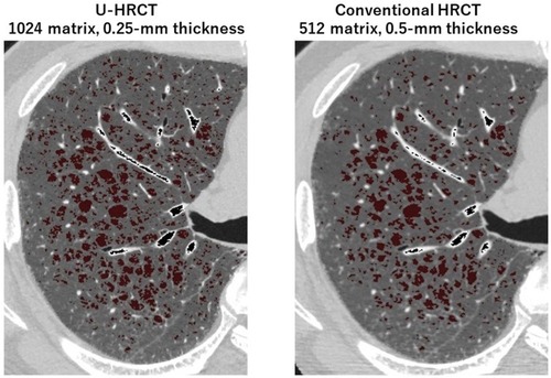 Figure 2 Ultra-high-resolution CT (U-HRCT) image compared with a conventional HRCT image for the detection of emphysema. At the threshold setting of <−950 Hounsfield units, emphysematous lesions are identified as dark-red areas on axial images. Some of the very small emphysematous lesions, which is clearly identified on the U-HRCT image (left), cannot be seen on the identical conventional HRCT image (right).