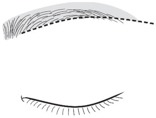 Figure 2 Planning the desirable postoperative eyebrow shape. The desirable eyebrow shape after surgery is shown (gray area). Postoperative descent of the eyebrow, which is generally observed after extended IBEB, has to be considered. It is unnecessary to transplant hair into the infrabrow operative scar (dotted line), as it would be covered by the regrowth of hair, made possible by incision perpendicular to the hair shafts.