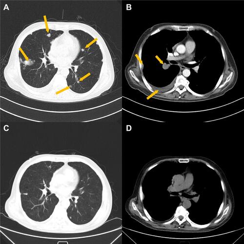 Figure 3 The lung and pleural metastasis were reduced after everolimus treatment. (A) CT image of lung metastasis before medication of everolimus. Arrows represent pulmonary metastases. (B) CT image of pleural metastasis before medication of everolimus. The arrow in the lower left corner represents the pleural effusion, and other arrows represent pulmonary metastases. (C) CT image of lung metastasis after everolimus treatment for 3 months. (D) CT image of pleural metastasis after everolimus treatment for 3 months.