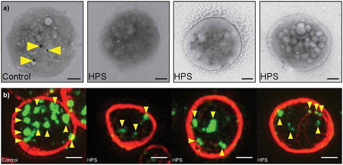 Figure 3. Granules in platelets from healthy controls and HPS patients.(a) Whole mount TEM images showing typical platelets from a control and three HPS patients. Dense granules are indicated with yellow arrowheads. Three are seen in the control platelet, none in the HPS platelets.(b) SIM images (typical platelets from images shown in Figure 4). Yellow arrowheads indicate the most intense CD63+ objects. The control platelet has more, and brighter, CD63+ structures. Note the variable morphology, size and intensity of the structures, which necessitates an automated algorithm to achieve consistent counting of granules. All scale bars are 1 µm.(a) Adapted from [Citation7] under the Creative Commons Licence. Full color available online.