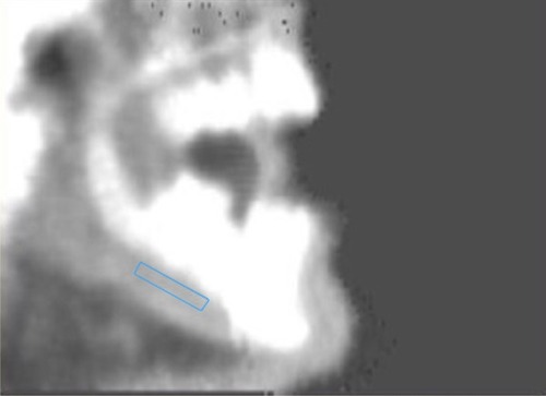 Figure 1 Measurement of mandibular BMD by dual-energy X-ray absorptiometry.