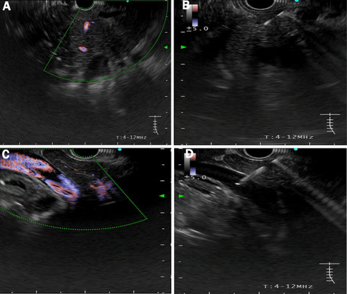 Figure 1 EUS-guided access of the portal vein. (A) Pancreatic mass was hypoechoic with poorly defined boundaries. (B) EUS-FNA to obtain histological cytology and histological examination. (C) The main portal vein was identified under EUS guidance with Doppler wave verification. (D) Puncture the primary vein with a needle for portal venous blood acquisition.