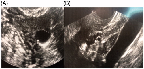 Figure 1. Transvaginal sonography of the ovaries with AFC = 1 37 years old infertile patient with oligomenorrhea.