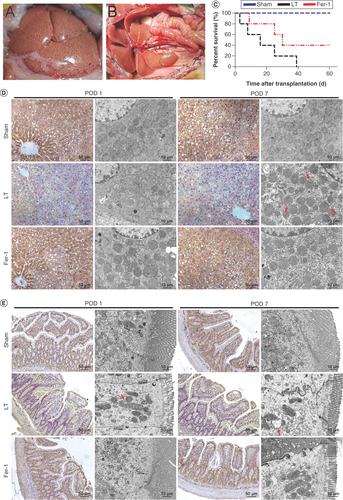 Figure 1. Changes in the morphology of severe steatotic liver grafts and ferroptosis in the liver and intestines after transplantation. (A) Severe steatotic liver grafts. (B) Liver transplantation with severe steatotic liver grafts. (C) Survival time after steatotic liver transplantation. (D) Immunohistochemistry of liver tissue GPX4 (×200) and electron microscopy showing ferroptosis in severe steatotic liver grafts after transplantation. The red arrow indicates mitochondrial outer membrane rupture. (E) Immunohistochemistry of intestinal tissue GPX4 (×200) and electron microscopy showing iron death in intestinal tissue after transplantation. The red arrow indicates mitochondrial outer membrane rupture.POD 1: Postoperative day 1; POD 7: Postoperative day 7.