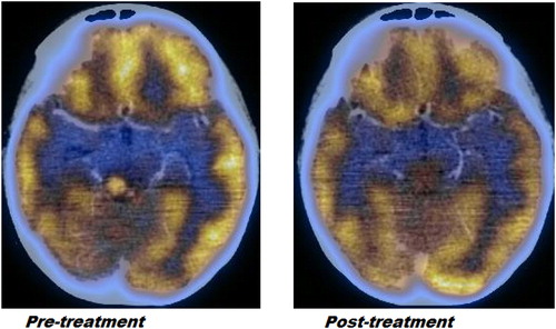 Figure 4. Pre-treatment and post-treatment positron emission tomography computed tomographic scan images of midbrain lesion suggestive of remission of disease.