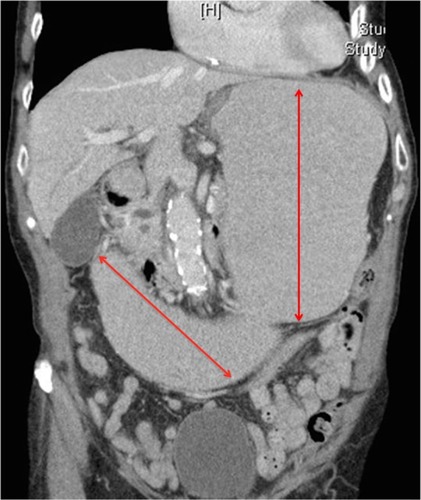 Figure 1 Computed tomography of the abdomen showing gastric and duodenal distention (red arrows) suggestive of small bowel obstruction and narrowing of the angle between the superior mesenteric artery and the abdominal aorta.