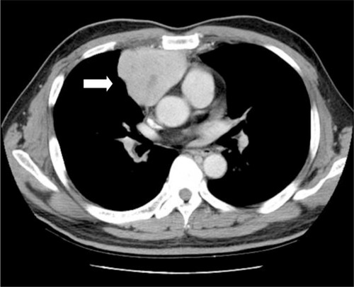 Figure 2 Chest CT showing an anterior mediastinal tumor, approximately 69 ×55 ×68 mm in size.