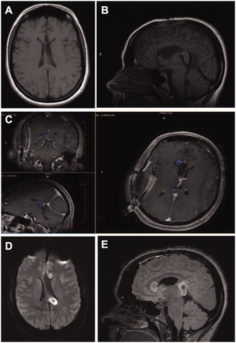Figure 2. Stereotactic LITT completion callosotomy in a patient with previous callosotomy. (A and B) Preoperative T1 axial (A) and sagittal (B) imaging demonstrating residual anterior corpus callosum and splenium of corpus callosum, which are targets of the planned ablation. (C) Intra-ablation MR thermography demonstrating ablation of the residural genu and splenium of the corpus callosum. (D and E) Postoperative axial (D) and sagittal (E) DWI MR images demonstrating complete callosotomy.