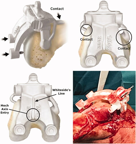 Figure 2. Placement of the X-PSI™ femoral guide. The X-PSI™ femoral guide was placed on the distal femur by first positioning the anterior tab on the anterior cortex and locking on the anterior part using the medial and lateral tabs. The metallic blades aligning with the distal condyles were then pushed by hand through the cartilage until they contacted the cortical bone. The guide position was confirmed using marks on the guide indicating the mechanical axis entry point and Whiteside’s line (bottom left image). Because the cut guide sits on specific contact points (unlike MRI-based PSI systems), the surrounding soft tissues do not interfere with the installation and positioning of the femoral guide (bottom right image).