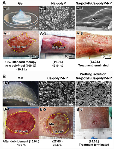 Figure 13 Application of polyP for the treatment of chronic wounds. (A) Application of the polymer in (A-1) a hydrogel supplemented with Na-polyP and Ca-polyP-NP to cure more superficial wound. (A-2) Formation of a coacervate after contact with Ca2+ in the wound bed. (A-3) The presence of Ca-polyP-NP served as a depot for retarded polyP release. The chronic wound was treated with (A-4) the hydrogel. (A-5) After a 8 weeks of treatment, the wound dimension shrunk by 87%. (A-6) After a total of 18 weeks, the patient could go back home (B) For deeper wounds, (B-1) collagen-based mats were fabricated after compressing the collagen fibers. (B-2) Orientation of Ca-polyP-NP on the collagen bundles. (B-3) Every second day, a wetting solution composed of Na-polyP and Ca-polyP-NP was used and dropped onto the wound to keep it moist. There the Na-polyP underwent coacervation. Treatment success with the polyP-containing mats. (B-4) Initial state after debridement; (B-5) a strong reduction was observed after 6 weeks of treatment; (B-6) final state prior to patient discharge. (A) Adapted with permission from J Mat Sci Technol. Volume 135, Müller WEG, Schepler H, Neufurth M, et al. The physiological polyphosphate as a healing biomaterial for chronic wounds: Crucial roles of its antibacterial and unique metabolic energy supplying properties. 170–185. Copyright 2023. Creative Commons.Citation49 (B) Adapted with permission from Schepler H, Neufurth M, Wang SF, et al. Acceleration of chronic wound healing by bio-inorganic polyphosphate: In vitro studies and first clinical applications. Theranostics. 2022;12:18–34. © 2022 Ivyspring. Creative Commons.Citation48