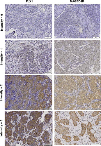 Figure 2. Expression of MAGED4B and FJX1 in HNSCC samples.Representative images of intensity scores for IHC staining, ranging from negative (intensity = 0), to weak (intensity = 1) and strong (intensity = 2–3) staining.