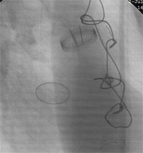 Figure 3 Third fluoroscopy.