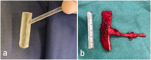 Figure 2. A sterile 3D printed model with a handlebar virtually designed to perfectly fit in the metacarpal defect after tumor resection was used for bone flap elevation. Corticocancellous MFC bone flap after elevation (b).