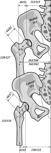 Figure 8. Schematic view of results presented as median values without/with hip OA. Observations at the hip region in patients with medial (top) and lateral (bottom) OA of the knee. In this example the midpelvis-shaft distances are the same. At the top the pelvis is more narrow, which has been compensated for by higher femoral offset. At the bottom the patient has a wide pelvis, but coxa valga resulting in a smaller femoral offset.